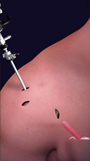 Torn Shoulder Labrum Repair Explained #3dmedicalanimation #aigenerated #shoulderpain #surgery #3d