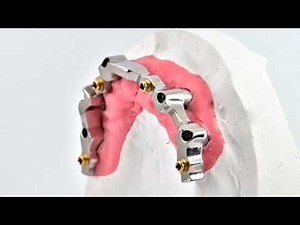 Protocollo digitale per riabilitazione protesica rimovibile a totale appoggio implantare