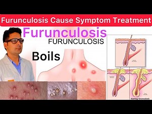 Furunculosis / Boils Cause Symptom Diagnosis Treatment | What is Furunculosis | Boils | Furunculosis