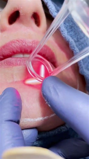 Fine Line & Wrinkle Reduction using DeepFX Resurfacing Laser | Dr. Hooman Khorasani