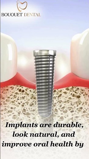 How Dentists Insert Dental Implants | Step-by-Step Guide to a Perfect Smile | Dr. Nishtha Glodha