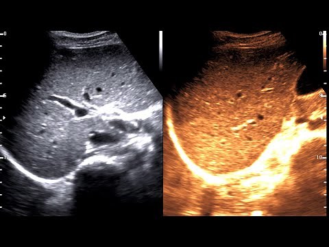 Gilberts syndrome || Ultrasound cases 1 of 2000