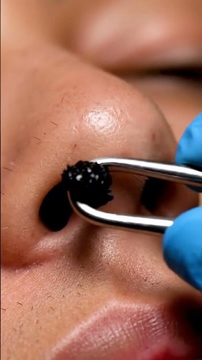 Under Nose Blackhead Extraction | Smooth Clean Pore Detail