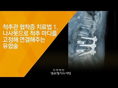 척추관 협착증 치료법 1. 나사못으로 척추 마디를 고정해 연결해주는 유합술 - (20180725_656회 방송) 허리 노화에 맞서라