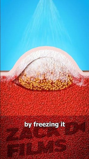 How Warts Are Frozen Off 🥶