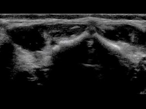 Spinal US - dorsal dermal sinus