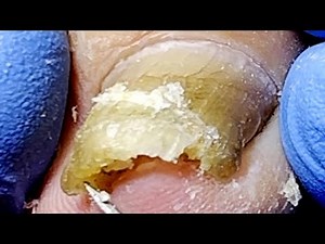 Huge Ingrown Toenail Successfully Trimmed!【Podiatry Clinic】