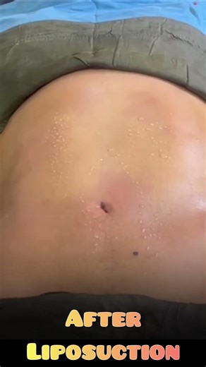 Real Tummy Liposuction Transformation 😱 Before & After | Fat Removal Surgery Explained