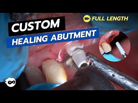 Immediate Implant with Custom Healing Abutment