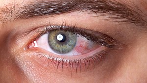 Hochansteckend, nicht zu behandeln - Was ist eine Augengrippe?
