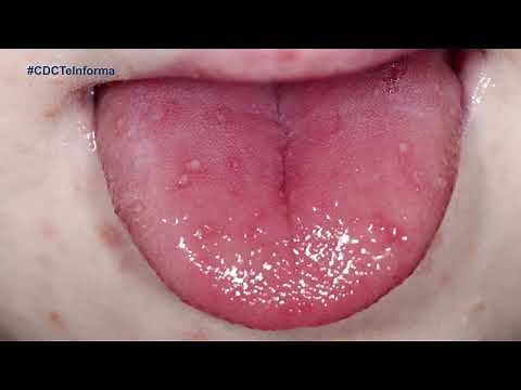 ¿Qué es la enfermedad de manos, pies y boca?