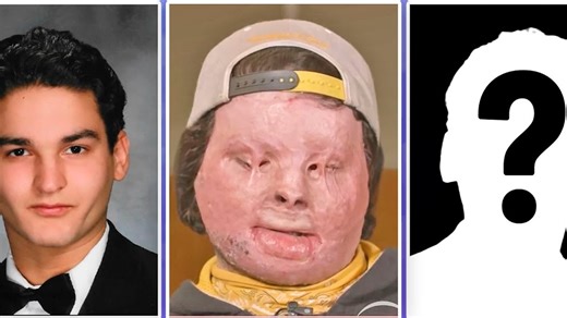 First face & double hand transplant explained