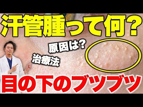 汗管腫は稗粒腫と違うの？原因と治療法（取り方）を医師が解説【目の下の白いブツブツ/できもの】
