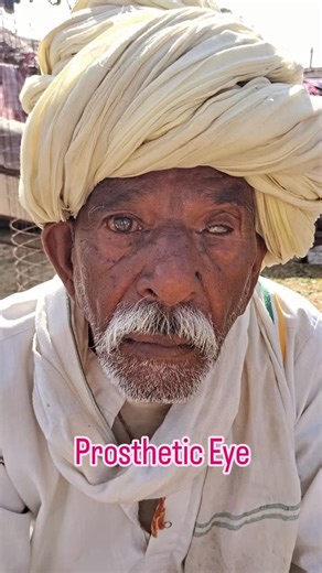 B.L. Eye Care Pisangan on Instagram: "A prosthetic eye (ocular prosthesis) is a custom-made, removable medical device that replaces an absent natural eye, enhancing appearance after trauma, disease, or surgery. Though it does not restore vision, modern acrylic, hand-painted prostheses match the healthy eye closely and can move with the eye socket . #bleyecare #pisangan #govindgarh #पीसांगन"