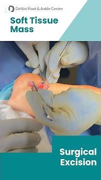 Excision of Soft Tissue Mass #excision #footsurgery #footdoctor