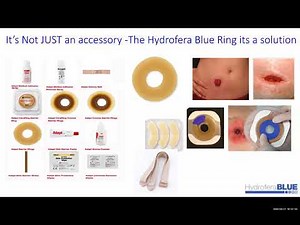 Ostomy Care with Hydrofera Blue Ostomy Ring