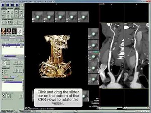 Vitrea Advanced vessel probe demo