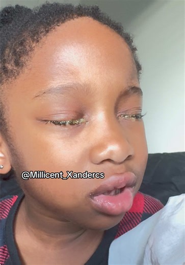 Understanding Conjunctivitis: Symptoms and Treatments