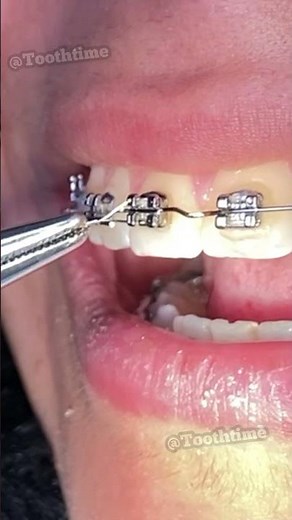 Braces Checkups - Bending orthodontic wire - Tooth Time Family Dentistry New Braunfels