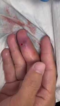 Right middle finger infection with pus