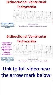 What is bidirectional ventricular tachycardia?