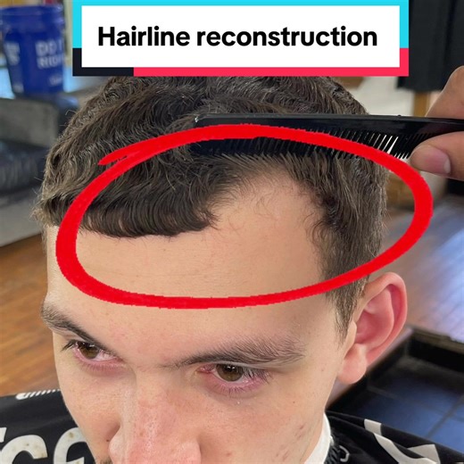 Hairline Reconstruction: Achieving the Perfect Mid Taper