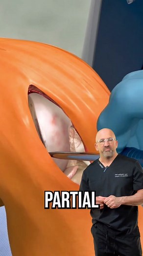 Understanding Partial Knee Replacement Surgery