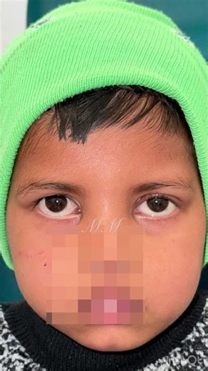 Outcomes of ptosis surgery in children #eyeplasticsurgeon #drmanjumeena #eyelidcosmeticsurgery