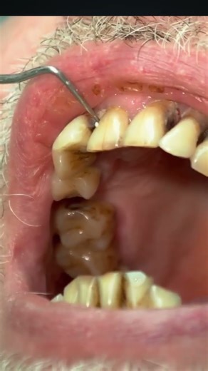 Why Your Cavity Needs a Specific Treatment #shorts