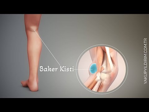 Baker Kisti: Belirtileri, Nedenleri ve Tedavi Yöntemleri | Prof. Dr. Yakup YILDIRIM