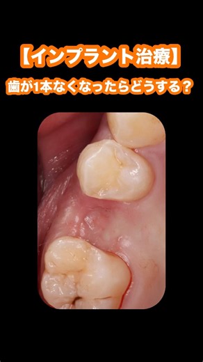 Missing a tooth? Don't just ignore it! Leaving it alone can cause your other teeth to shift and l...