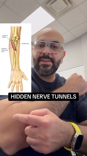 The Hidden Tunnels of Nerve Compression: Are Your Symptoms Being Missed? 🔍 Ever heard of the Arcade of Frohse? It’s a hidden spot in your forearm where the radial nerve can get trapped, leading to weakness in your wrist and fingers – without the numbness typical of other nerve issues! 👀 Nerve compressions can be tricky to diagnose, especially with the countless tunnels in our bodies where nerves can get pinched. Most symptoms won’t resolve unless the nerve compression is identified and address