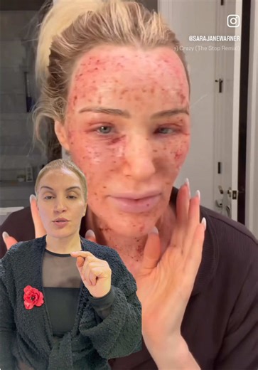 Lumenis Ü ultrapulse Alpha CO2 Lazer Tedavisi Süreci