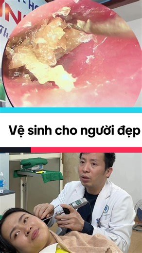 Vệ sinh tai cho người đẹp#nutraytai #vesinhtaichonguoilon #vesinhtaichuanykhoa #earwaxcleaning #