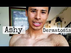 What's on my Neck (Rash)? Ashy dermatosis