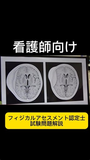 【フィジカルアセスメント認定士】YouTubeライブ切り抜き#看護師 #特定看護師 #診療の補助の強化書 #出直し看護塾 #切り抜き