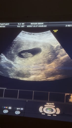 ESTEFANI AREVALO on Instagram: "I’m so glad I listened to a few of you who DM’d me and encouraged me to get the ultrasound pictures before the miscarriage. I’m really thankful I did so thank you 🤍 Mamas, if you’re considering it, go for it too. #pregnancyloss"