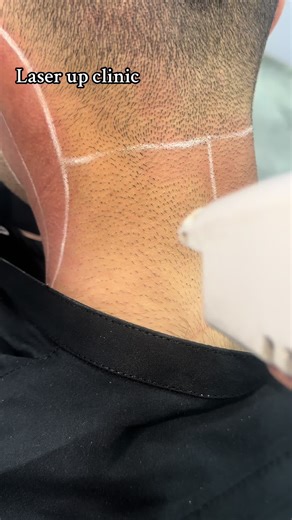Effective Laser Hair Removal at Laser Up Clinic