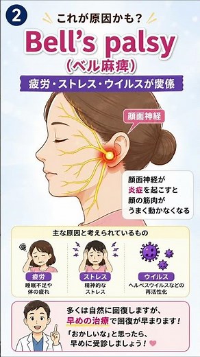 【顔面神経麻痺ってなに？】突然、顔が片方だけ動かなくなる「Bell’s palsy（ベル麻痺）」。