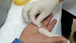 MINIMALLY INVASIVE, PERCUTANEOUS RELEASE OF TRIGGER FINGER, REAL TIME DEMO