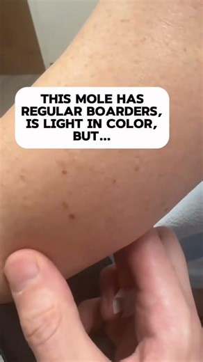 To the naked eye, this small mole looks normal: ✅ small ✅ regular borders ✅ light brown