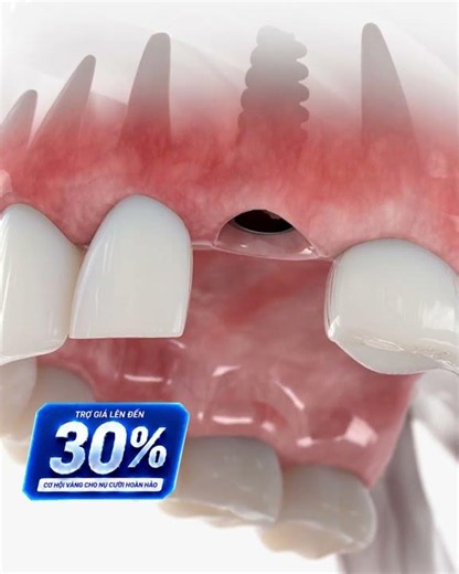 TRỒNG RĂNG IMPLANT – MUA TRỤ TẶNG RĂNG #nhakhoasaigon #implant