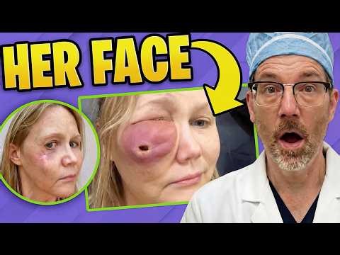 Facial Fillers DESTROYED Her Face! Plastic Surgeon Reacts