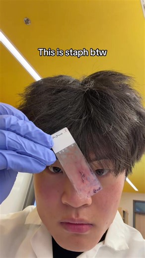 Staphylococcus aureus (never had btw) | staph