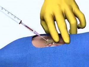 Arterial puncture | General Nursing Students