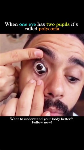 @medicalstudent.io | Polycoria is an extremely rare eye condition where a person appears to have two pupils in one eye, and in true cases, both pupils may... | Instagram