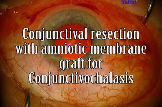 Conjunctival resection with amniotic membrane graft for conjunctivochalasis