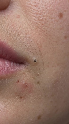 Lip Blackhead Removal: Safe Methods & Best Products