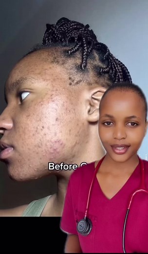 Nosi_iii's Isotretinoin Journey: Mind-Blowing Results | Dermatologist's Advice