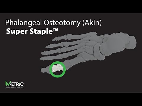 Phalangeal Osteotomy Video (Akin) - Super Staple™